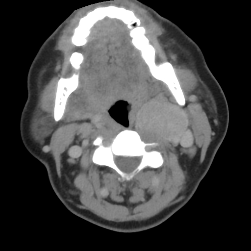 Carotid body tumor (paraganglioma) (Radiopaedia 38586-40729 A 51).jpg