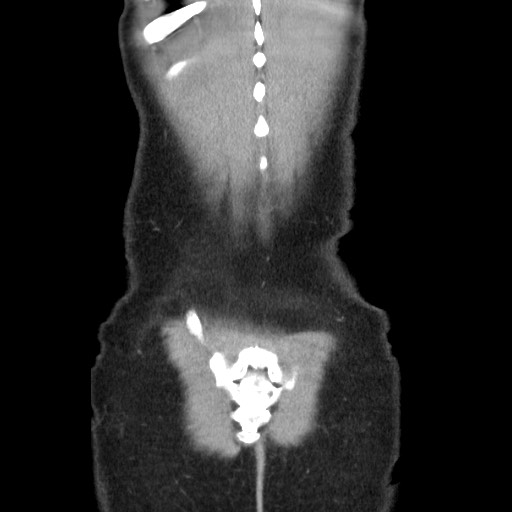 Castleman disease with fibrous pseudotumor in the abdomen (Radiopaedia 77296-89373 B 87).jpg
