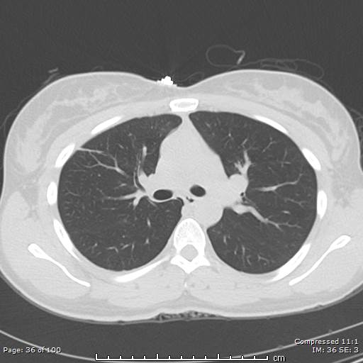 Catamenial pneumothorax (Radiopaedia 54382-60600 Axial non-contrast 36).jpg