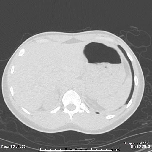 Catamenial pneumothorax (Radiopaedia 54382-60600 Axial non-contrast 85).jpg