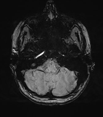 File:Cavernoma with bleed - midbrain (Radiopaedia 54546-60773 Axial SWI 11).png