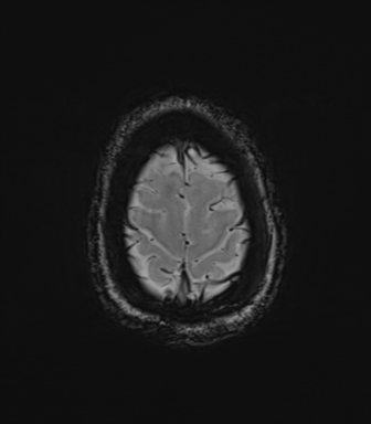 File:Cavernoma with bleed - midbrain (Radiopaedia 54546-60773 Axial SWI 44).png