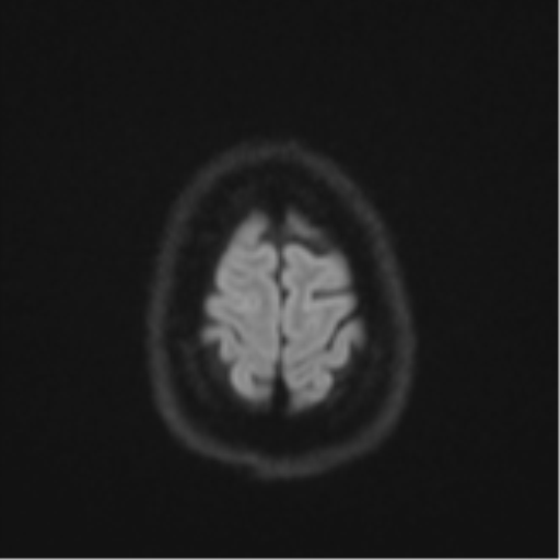 File:Cavernoma with bleed - midbrain (Radiopaedia 54546-60774 Axial DWI 53).png