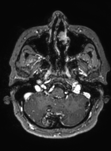 Cavernous hemangioma of the cerebellar falx (Radiopaedia 73025-83724 Axial T1 C+ 279).jpg