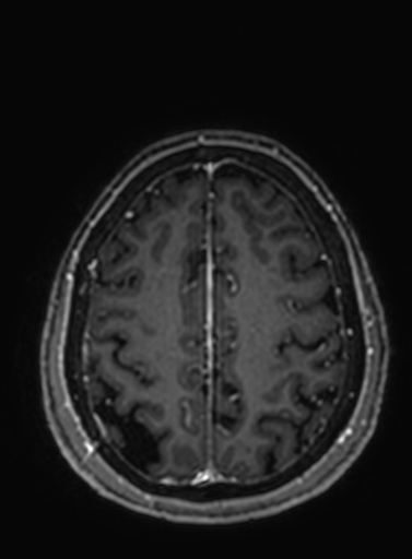 Cavernous hemangioma of the cerebellar falx (Radiopaedia 73025-83724 Axial T1 C+ 86).jpg