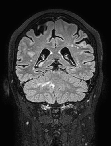 Cavernous hemangioma of the cerebellar falx (Radiopaedia 73025-83724 Coronal FLAIR 240).jpg