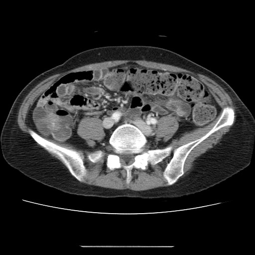 Cavernous hepatic hemangioma (Radiopaedia 75441-86667 B 79).jpg