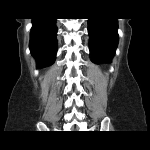 Cavernous hepatic hemangioma (Radiopaedia 75441-86667 C 121).jpg