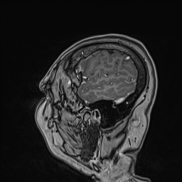 Cavernous sinus meningioma (Radiopaedia 63682-72367 Sagittal T1 C+ 144).jpg