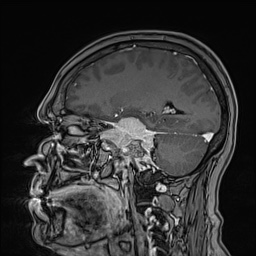 Cavernous sinus meningioma (Radiopaedia 63682-72367 Sagittal T1 C+ 70).jpg