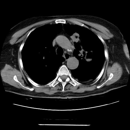 File:Cavitating pulmonary metastases (Radiopaedia 89545-106544 Axial non-contrast 19).jpg