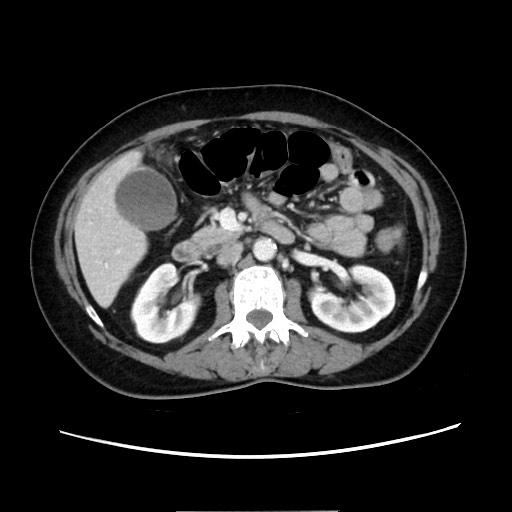 Cecal adenocarcinoma (Radiopaedia 75909-87331 A 38).jpg