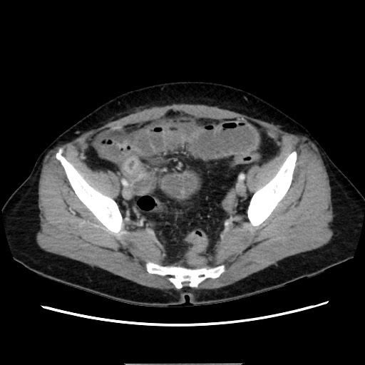 Cecal adenocarcinoma (Radiopaedia 75909-87331 A 73).jpg