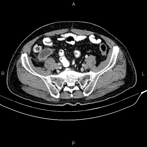 File:Cecal cancer with appendiceal mucocele (Radiopaedia 91080-108651 B 80).jpg