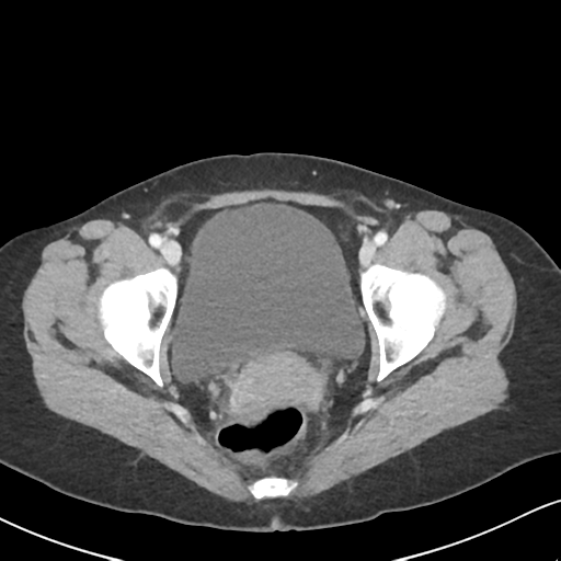 Cecal internal hernia through the foramen of Winslow (Radiopaedia 44820-48651 B 71).png