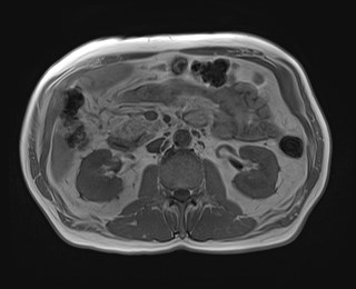 Cecal mass causing appendicitis (Radiopaedia 59207-66532 Axial T1 in-phase 60).jpg