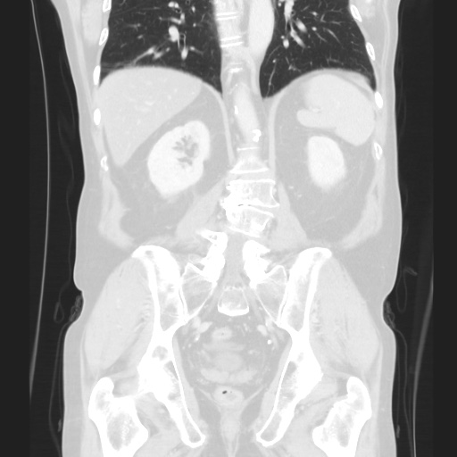 Cecal volvulus (Radiopaedia 75378-86620 Coronal lung window 96).jpg