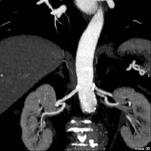 File:Celiac artery anatomy (Radiopaedia 16763-16476 A 15).jpg