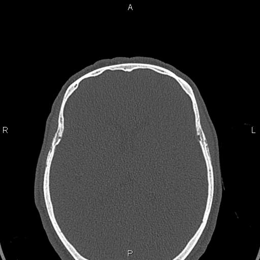 File:Central giant cell granuloma (Radiopaedia 83346-97761 Axial bone window 85).jpg