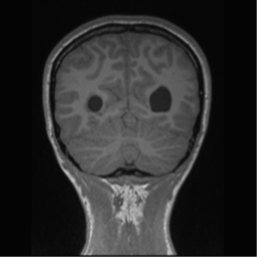 Central neurocytoma (Radiopaedia 37664-39557 Coronal T1 22).png