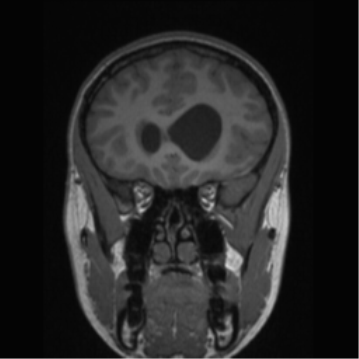 Central neurocytoma (Radiopaedia 37664-39557 Coronal T1 64).png