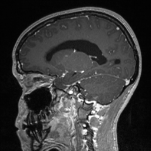 Central neurocytoma (Radiopaedia 37664-39557 Sagittal T1 C+ 61).png