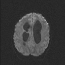 Central neurocytoma (Radiopaedia 56690-63469 Axial DWI 53).jpg