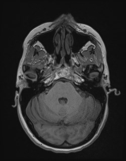 Central neurocytoma (Radiopaedia 84497-99872 Axial T1 56).jpg