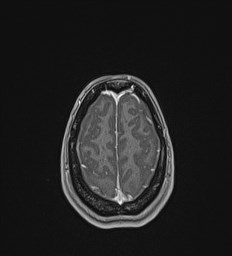Central neurocytoma (Radiopaedia 84497-99872 Axial T1 C+ 133).jpg
