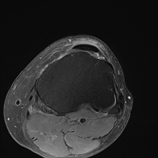 File:Central osteophyte (Radiopaedia 72592-83151 Axial PD fat sat 28).jpg