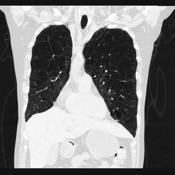 Centrilobular pulmonary emphysema (Radiopaedia 24495-24789 Coronal lung window 22).jpg