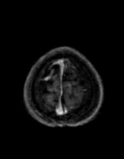 Cerebellar abscess (Radiopaedia 73727-84563 Axial T1 C+ fat sat 100).jpg