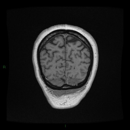 Cerebellar abscess (Radiopaedia 78135-90678 Coronal T1 C+ 148).jpg