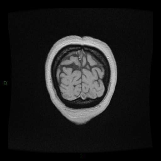 Cerebellar abscess (Radiopaedia 78135-90678 Coronal T1 C+ 161).jpg