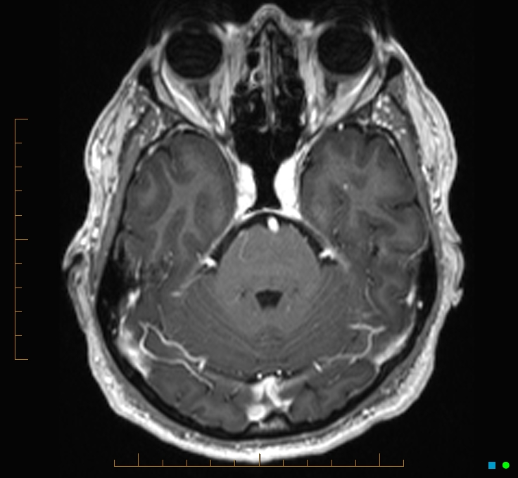 Cerebellar gangliocytoma (Radiopaedia 65377-74422 Axial T1 C+ 35).jpg