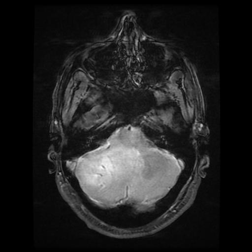File:Cerebellar hemangioblastoma (Radiopaedia 88055-104622 Axial Gradient Echo 5).jpg