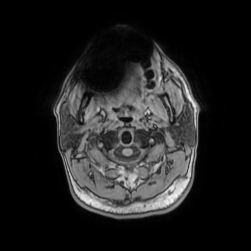 File:Cerebellar hemangioblastoma (Radiopaedia 88055-104622 Axial T1 2).jpg