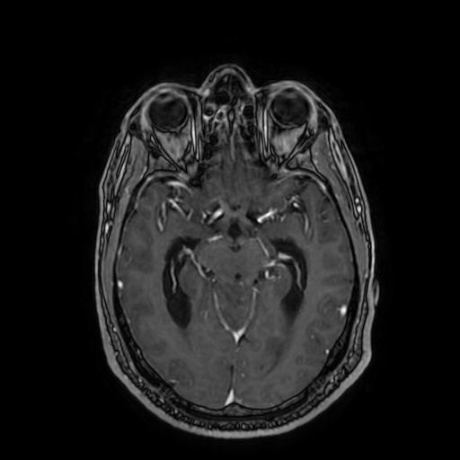 Cerebellar hemangioblastoma (Radiopaedia 88055-104622 Axial T1 C+ 82).jpg