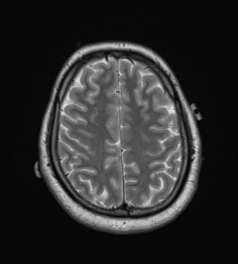 File:Cerebellar hemangioblastomas and pituitary adenoma (Radiopaedia 85490-101176 Axial T2 28).png