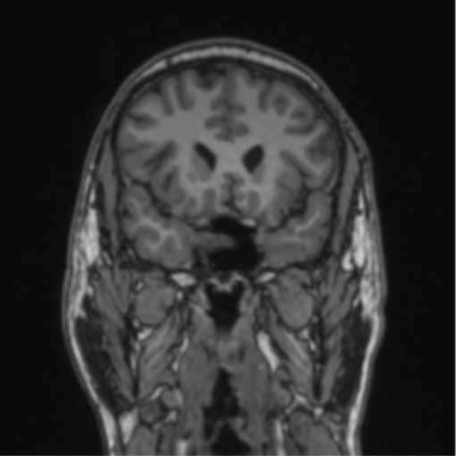 Cerebellar hemangioblastomas and pituitary adenoma (Radiopaedia 85490-101176 Coronal T1 62).png