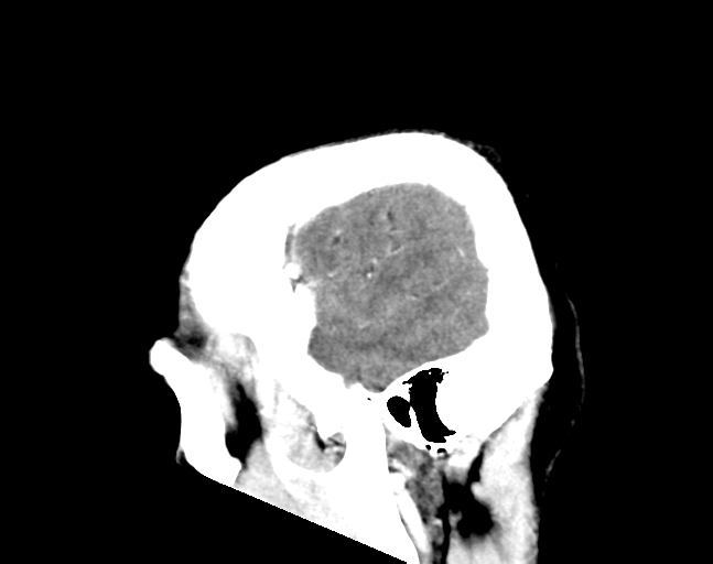 File:Cerebellar hemorrhage (Radiopaedia 37000-38671 Sagittal C+ 30).png