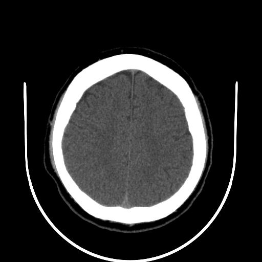 File:Cerebellar infarction (Radiopaedia 16625-16327 Axial non-contrast 29).jpg
