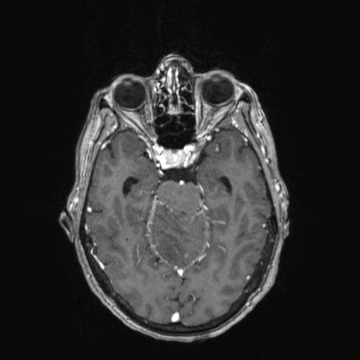 Cerebellar metastases (Radiopaedia 24038-24249 Axial T1 C+ 24).jpg