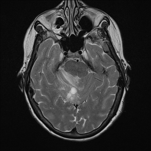 File:Cerebellar metastases (Radiopaedia 24038-24249 Axial T2 7).jpg