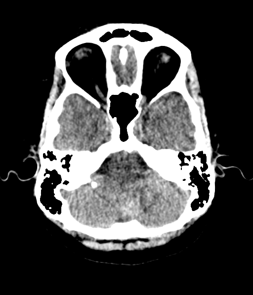 File:Cerebellar metastases - colorectal adenocarcinoma (Radiopaedia 40947-43652 Axial non-contrast 13).png