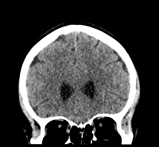 Cerebellar metastases - colorectal adenocarcinoma (Radiopaedia 40947-43652 Coronal non-contrast 31).png