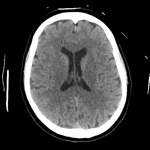 Cerebellar metastasis (cystic appearance) (Radiopaedia 41395-44258 Axial non-contrast 32).png