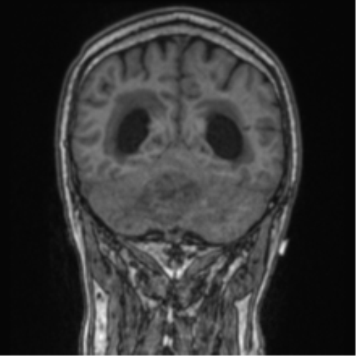 Cerebellar metastasis from lung adenocarcinoma (Radiopaedia 86690-102829 Coronal T1 31).png