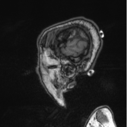 Cerebellar metastasis from lung adenocarcinoma (Radiopaedia 86690-102829 Sagittal T1 84).png
