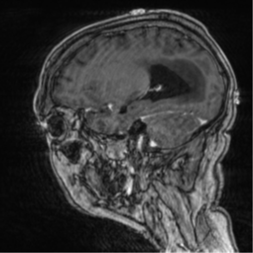 Cerebellar metastasis from lung adenocarcinoma (Radiopaedia 86690-102829 Sagittal T1 C+ 25).png